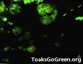Bo tehnika fluorescence pomagala bolnikom z rakom jajčnika?